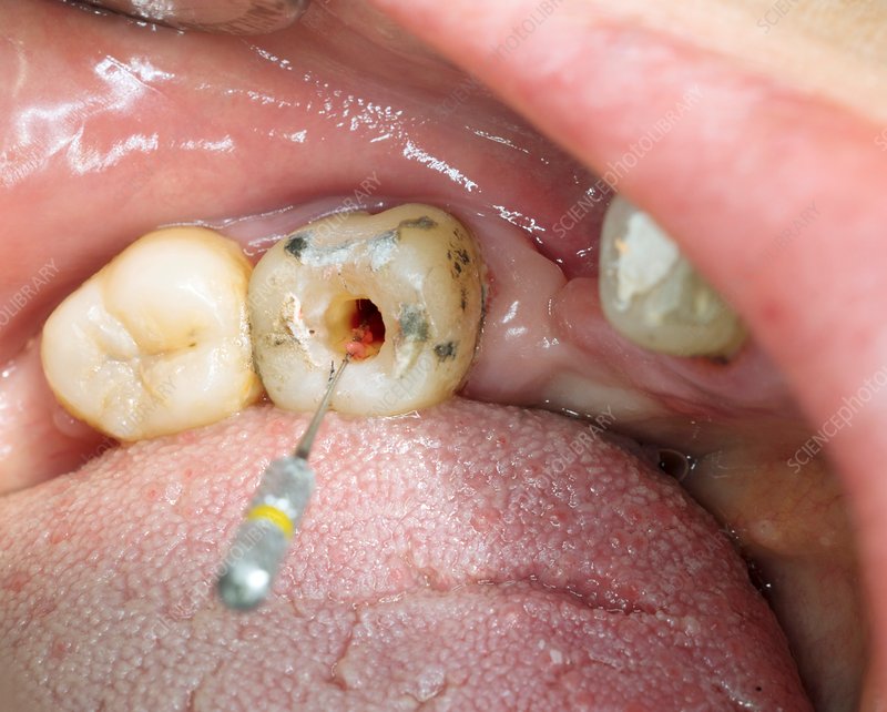 Endodontic Therapy